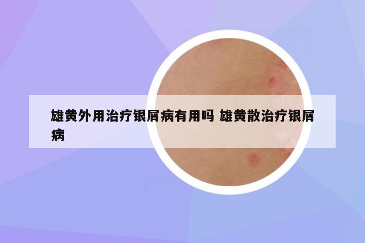 雄黄外用治疗银屑病有用吗 雄黄散治疗银屑病