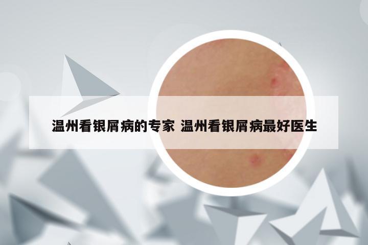 温州看银屑病的专家 温州看银屑病最好医生