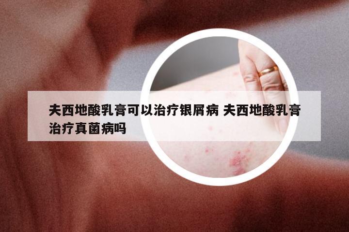 夫西地酸乳膏可以治疗银屑病 夫西地酸乳膏治疗真菌病吗