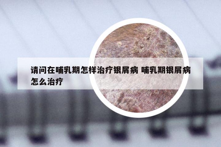 请问在哺乳期怎样治疗银屑病 哺乳期银屑病怎么治疗