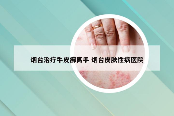 烟台治疗牛皮癣高手 烟台皮肤性病医院