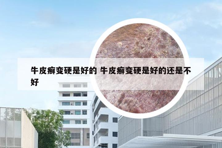 牛皮癣变硬是好的 牛皮癣变硬是好的还是不好