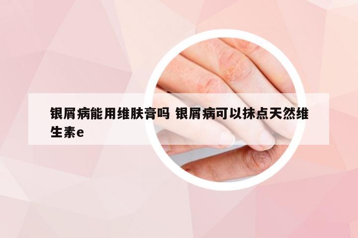 银屑病能用维肤膏吗 银屑病可以抹点天然维生素e