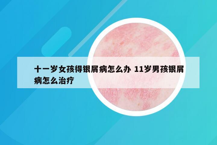 十一岁女孩得银屑病怎么办 11岁男孩银屑病怎么治疗
