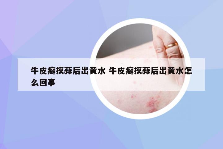 牛皮癣摸蒜后出黄水 牛皮癣摸蒜后出黄水怎么回事