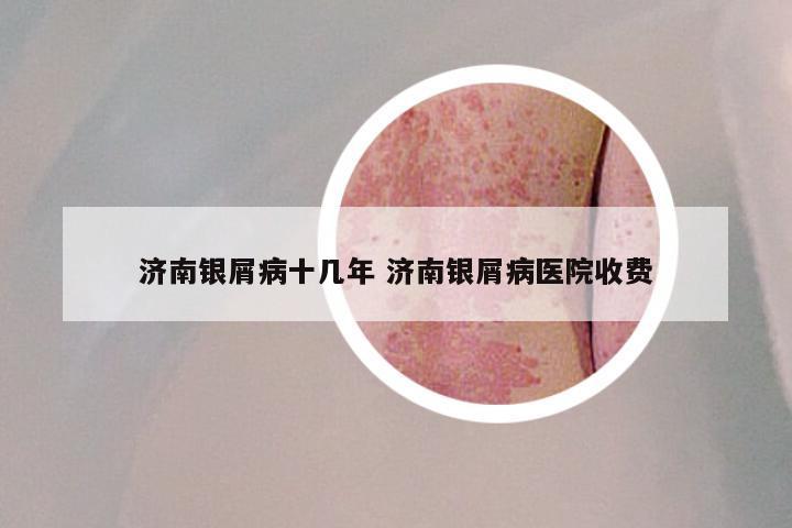 济南银屑病十几年 济南银屑病医院收费