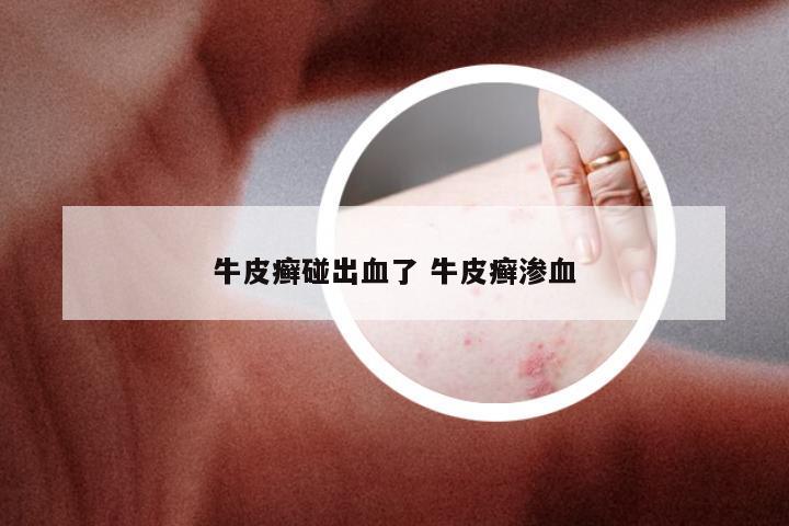 牛皮癣碰出血了 牛皮癣渗血