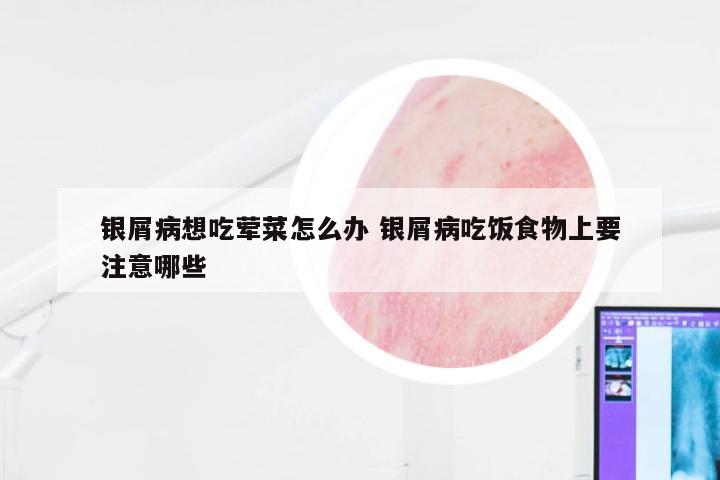 银屑病想吃荤菜怎么办 银屑病吃饭食物上要注意哪些