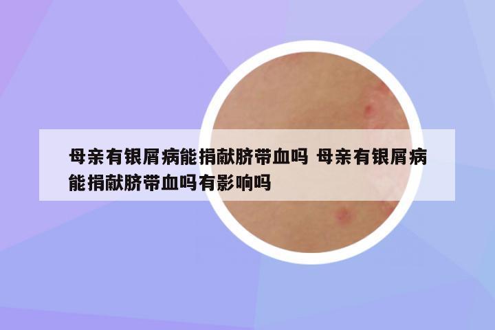 母亲有银屑病能捐献脐带血吗 母亲有银屑病能捐献脐带血吗有影响吗