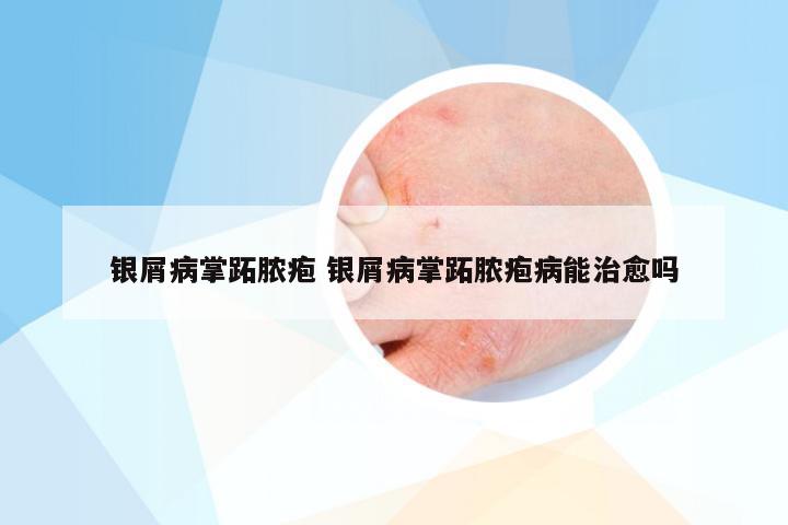银屑病掌跖脓疱 银屑病掌跖脓疱病能治愈吗