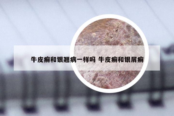 牛皮癣和银翘病一样吗 牛皮癣和银屑癣