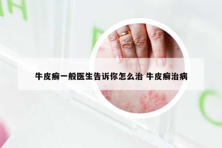 牛皮癣一般医生告诉你怎么治 牛皮癣治病