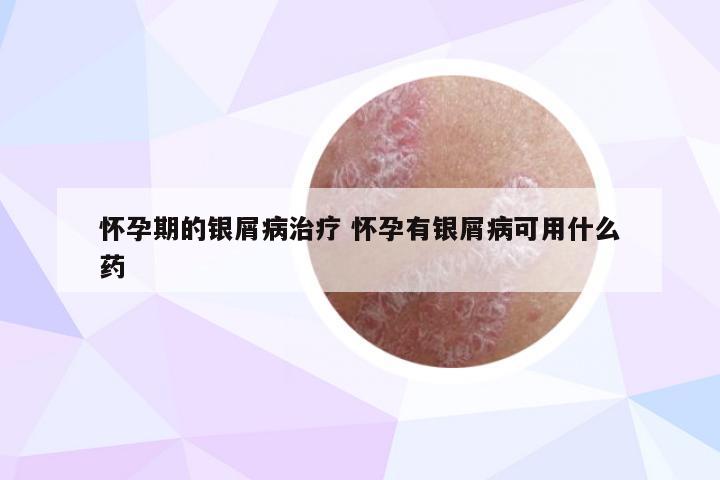 怀孕期的银屑病治疗 怀孕有银屑病可用什么药