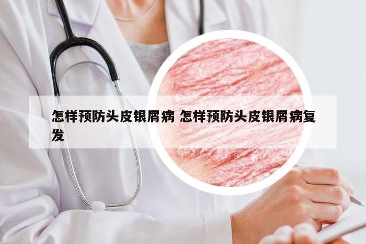 怎样预防头皮银屑病 怎样预防头皮银屑病复发