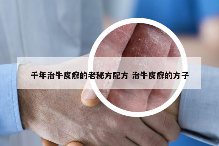 千年治牛皮癣的老秘方配方 治牛皮癣的方子