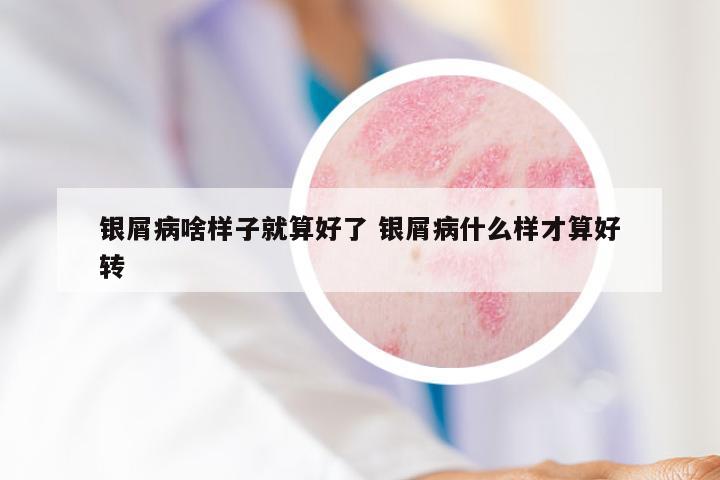 银屑病啥样子就算好了 银屑病什么样才算好转