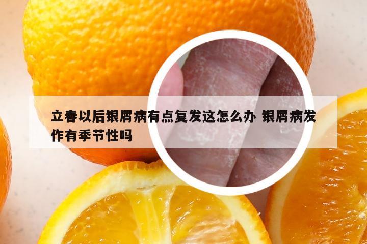 立春以后银屑病有点复发这怎么办 银屑病发作有季节性吗