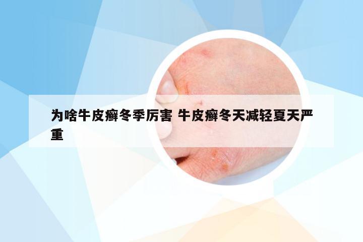 为啥牛皮癣冬季厉害 牛皮癣冬天减轻夏天严重