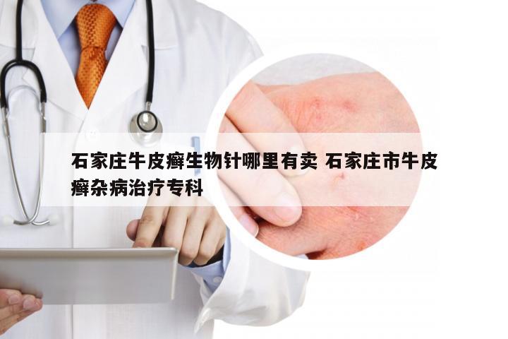 石家庄牛皮癣生物针哪里有卖 石家庄市牛皮癣杂病治疗专科