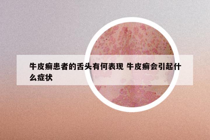 牛皮癣患者的舌头有何表现 牛皮癣会引起什么症状