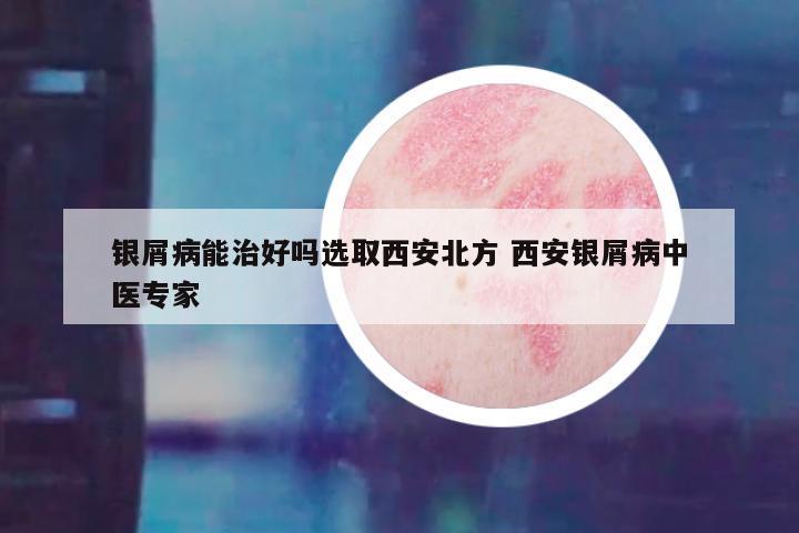 银屑病能治好吗选取西安北方 西安银屑病中医专家