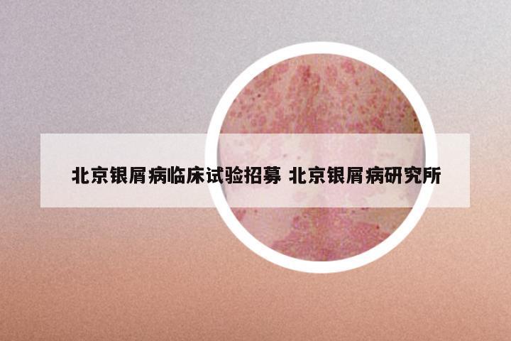 北京银屑病临床试验招募 北京银屑病研究所