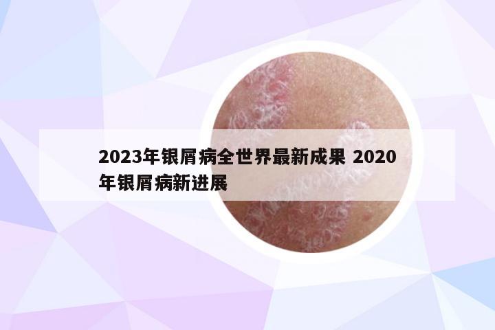 2023年银屑病全世界最新成果 2020年银屑病新进展