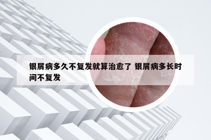 银屑病多久不复发就算治愈了 银屑病多长时间不复发