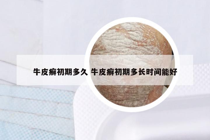 牛皮癣初期多久 牛皮癣初期多长时间能好