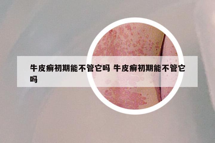牛皮癣初期能不管它吗 牛皮癣初期能不管它吗