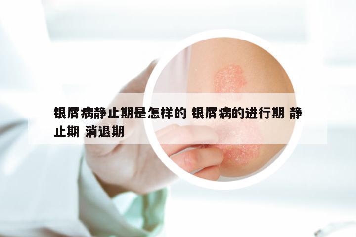 银屑病静止期是怎样的 银屑病的进行期 静止期 消退期