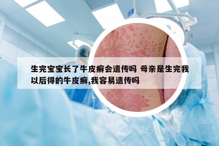 生完宝宝长了牛皮癣会遗传吗 母亲是生完我以后得的牛皮癣,我容易遗传吗