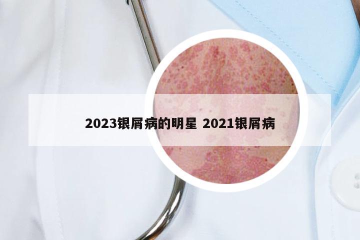 2023银屑病的明星 2021银屑病