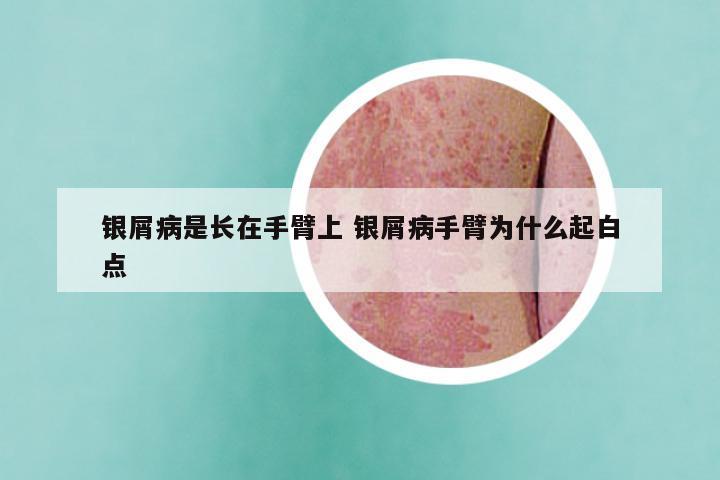银屑病是长在手臂上 银屑病手臂为什么起白点