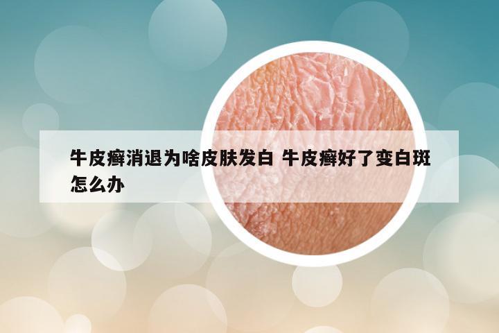 牛皮癣消退为啥皮肤发白 牛皮癣好了变白斑怎么办