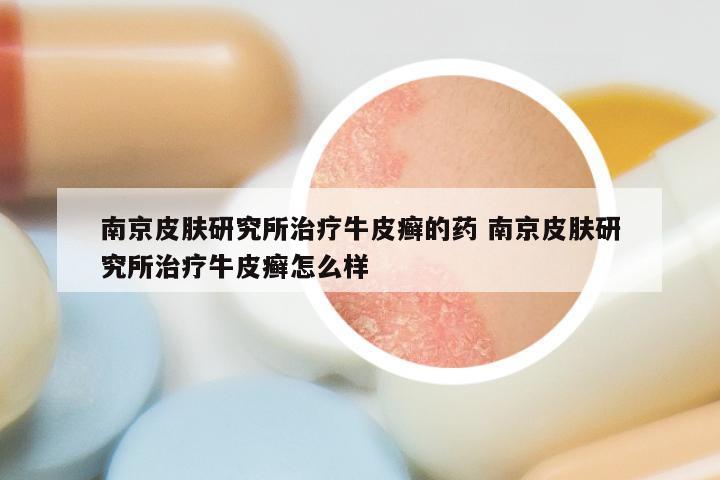 南京皮肤研究所治疗牛皮癣的药 南京皮肤研究所治疗牛皮癣怎么样
