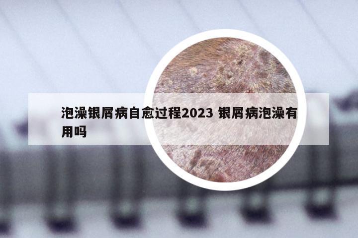 泡澡银屑病自愈过程2023 银屑病泡澡有用吗