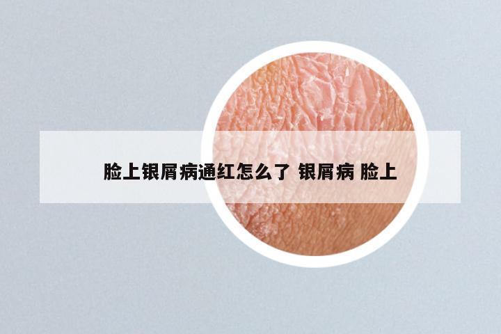 脸上银屑病通红怎么了 银屑病 脸上