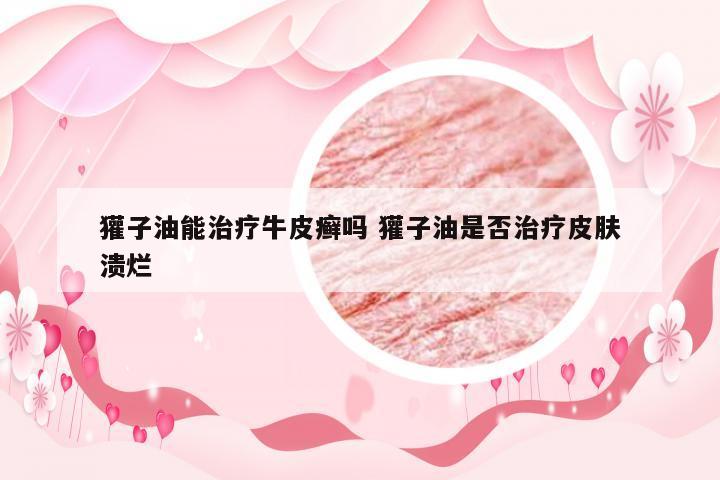 獾子油能治疗牛皮癣吗 獾子油是否治疗皮肤溃烂
