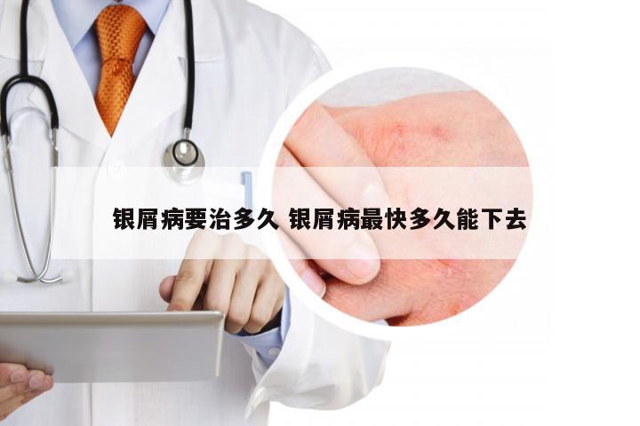 银屑病要治多久 银屑病最快多久能下去