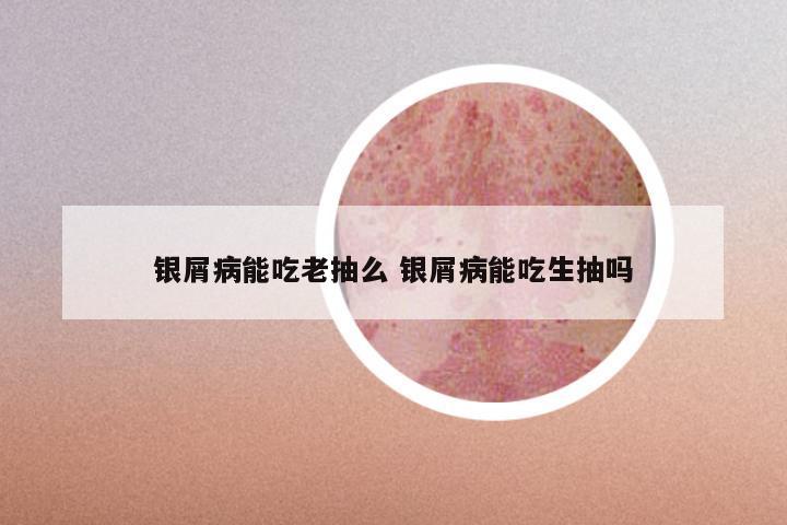 银屑病能吃老抽么 银屑病能吃生抽吗