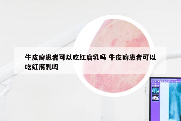 牛皮癣患者可以吃红腐乳吗 牛皮癣患者可以吃红腐乳吗