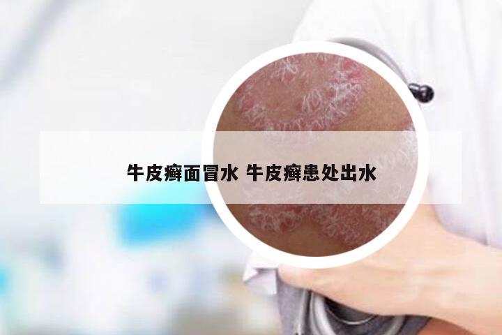 牛皮癣面冒水 牛皮癣患处出水