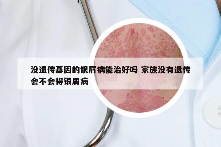 没遗传基因的银屑病能治好吗 家族没有遗传会不会得银屑病